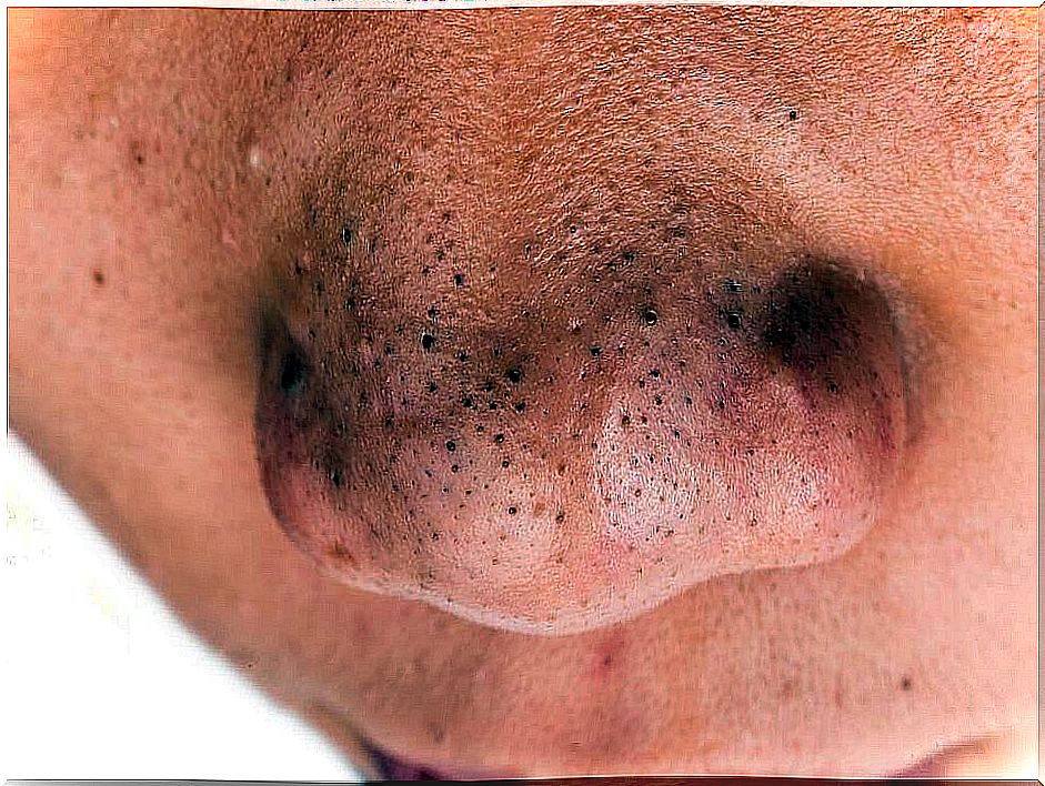 Black spots on the nose