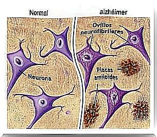 Comparison between a normal brain and a brain with Alzheimer's disease