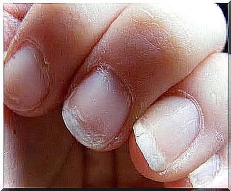 Weak nails