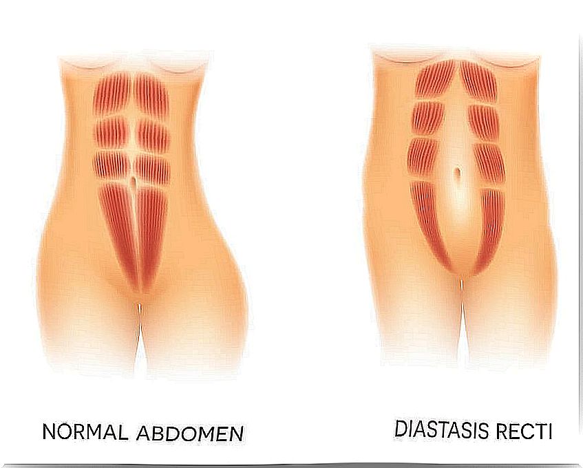 What is diastasis rectus abdominis?