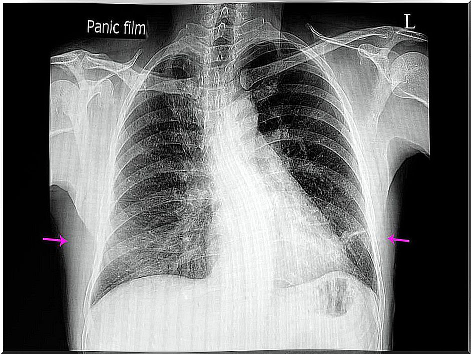 Atelectasis: symptoms and causes