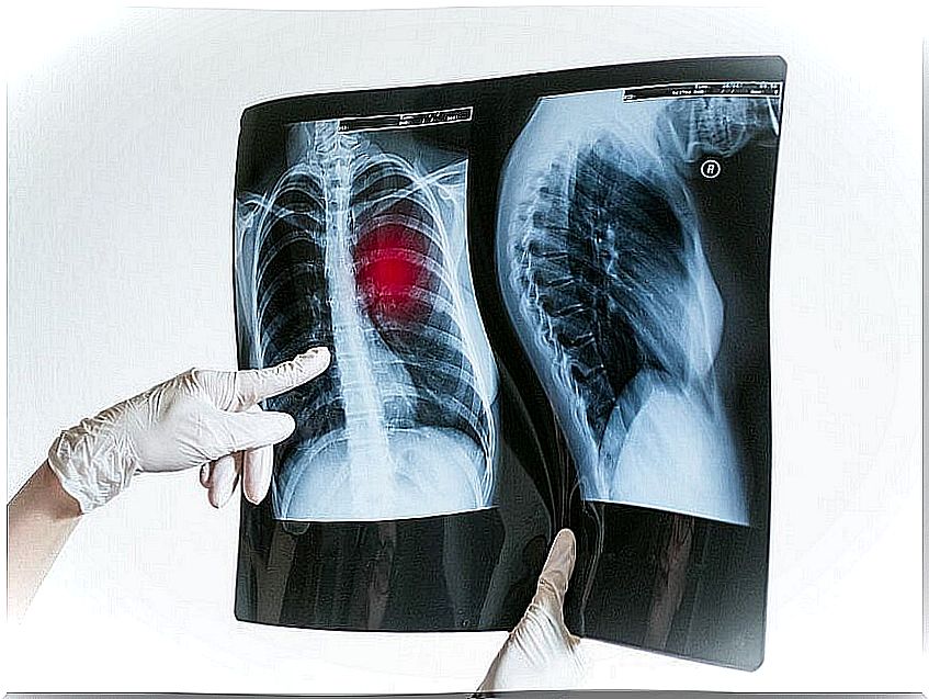 Lungs affected by pneumonia