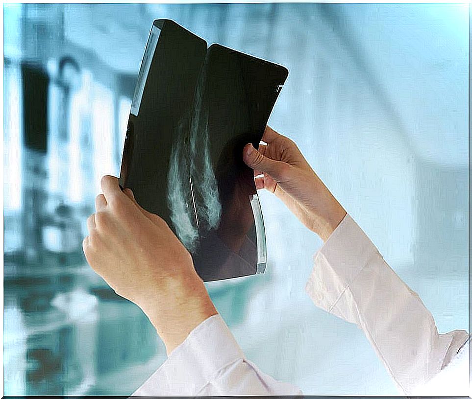 The diagnosis of bronchopulmonary sequestration can be made by radiography.