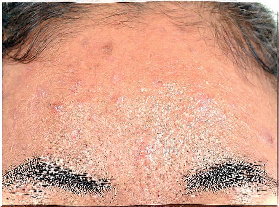 Seborrheic dermatitis.