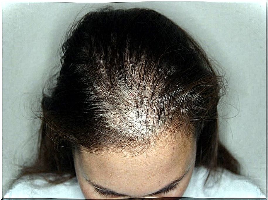 Alopecia