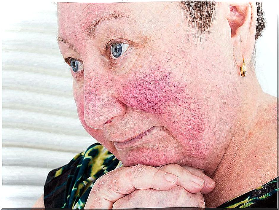 Rosacea