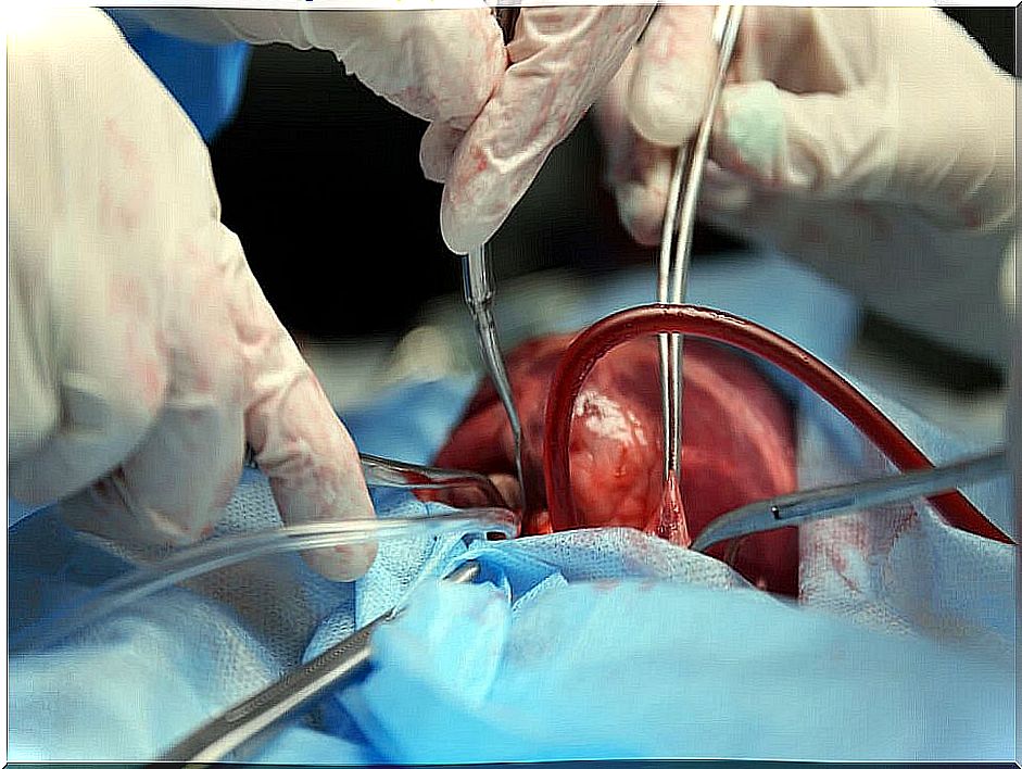 Heart operation