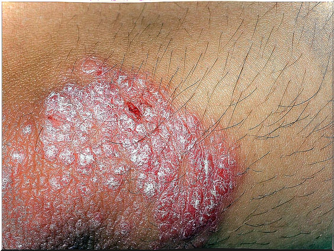 Eczema on the skin