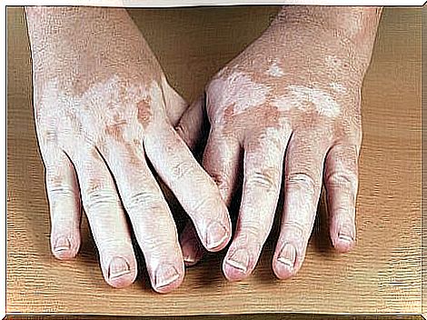 Natural recommendations to improve vitiligo