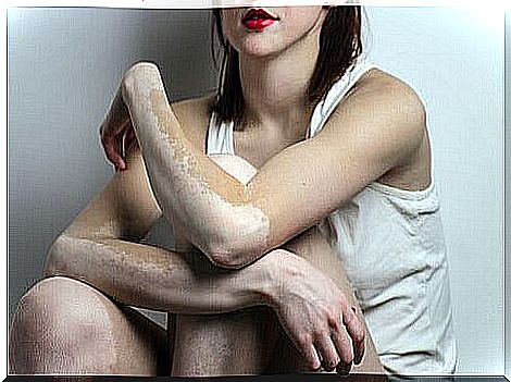 Discover the causes of vitiligo