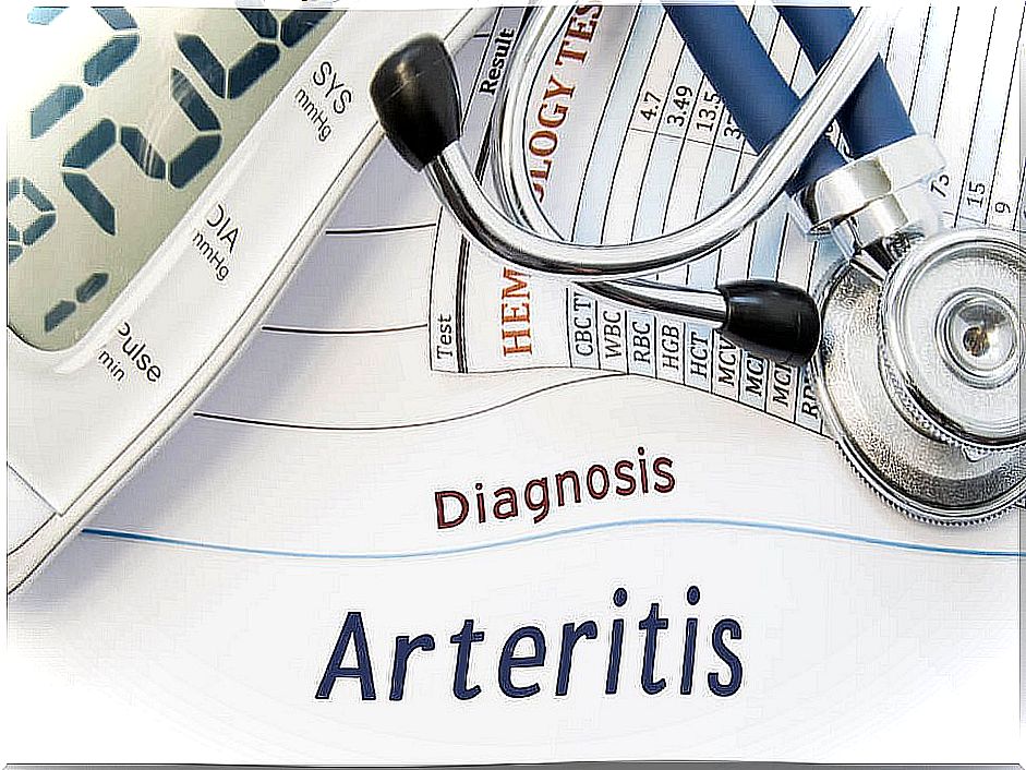 Takayasu arteritis: inflammation affecting the large vessels