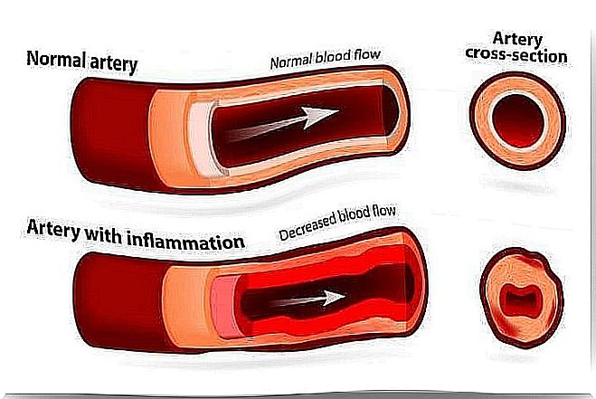 Takayasu arteritis