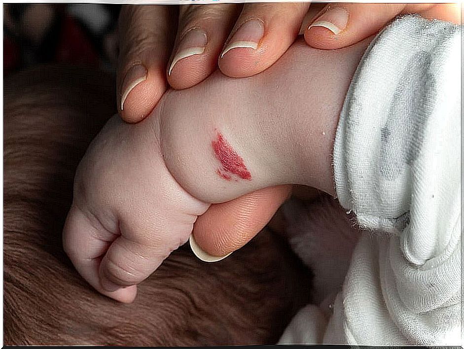 Baby with an angioma on the arm.