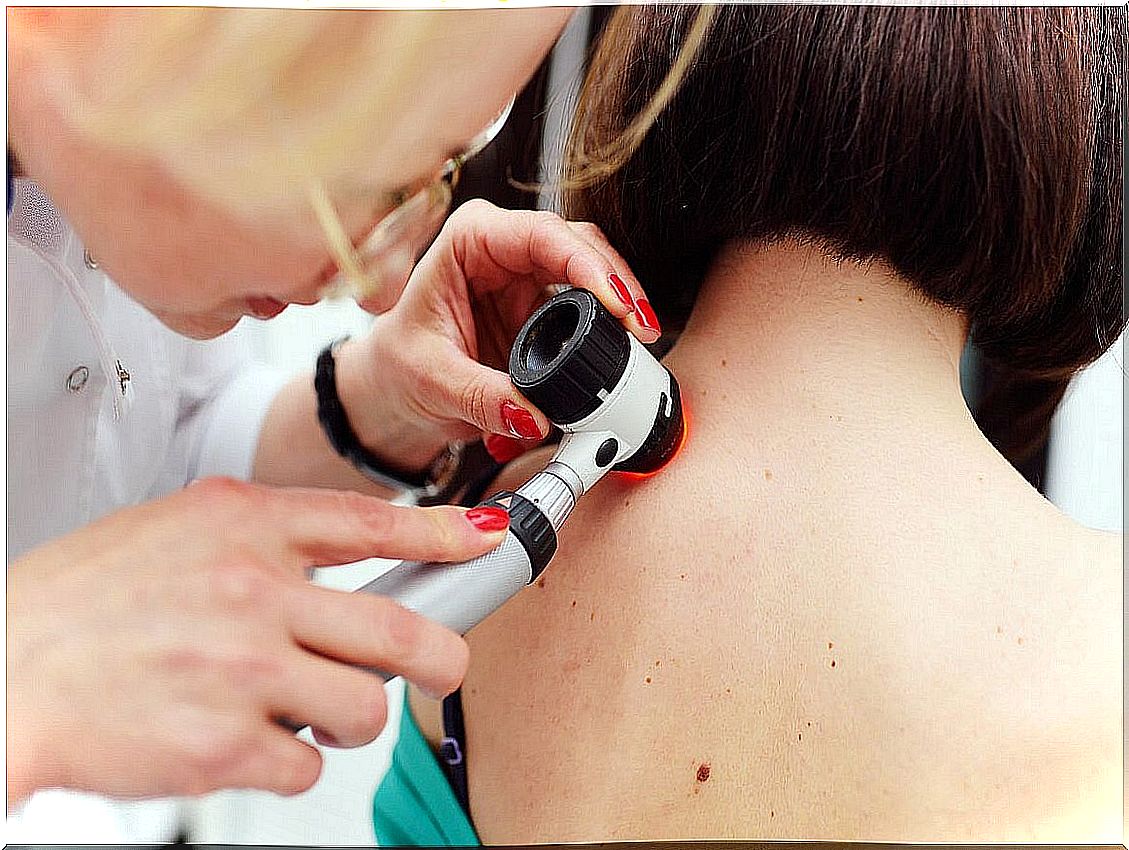 Skin tags: causes and risk factors.