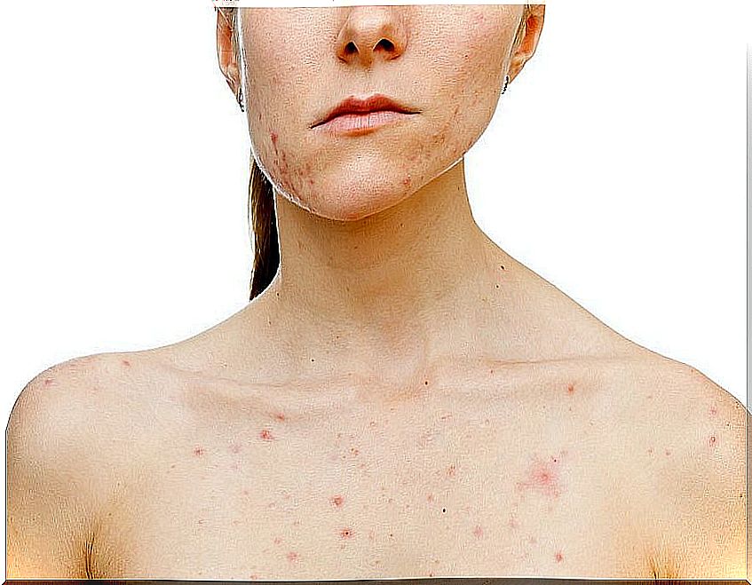 What triggers acne in women?